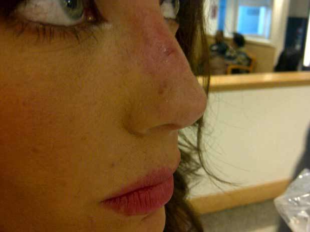 Anahí muestra fotografía con nariz golpeada