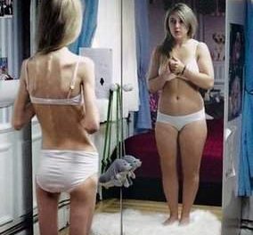 Anorexia y Bulimia: Falsos espejos