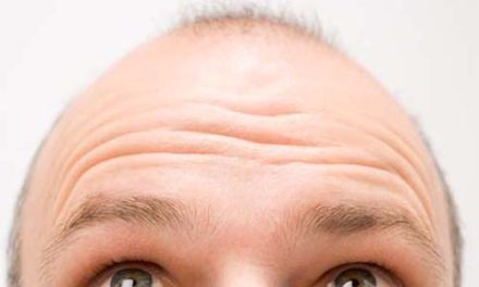 Alopecia: 5 mitos sobre la caída del cabello
