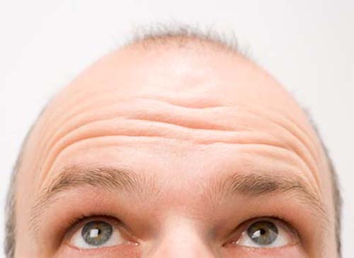 Alopecia: 5 mitos sobre la caída del cabello