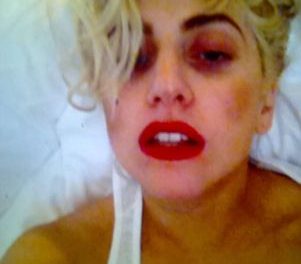 Lady Gaga muestra su ojo morado tras accidente en escenario
