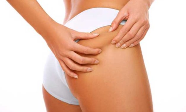 Velashape II: Tratamiento integral, seguro y eficaz para combatir la celulitis