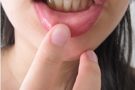 AFTAS EN LA BOCA PUEDEN SER SEÑALES DE ENFERMEDAD DE CROHN