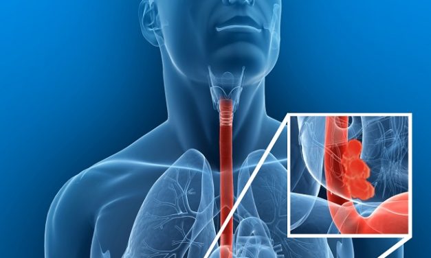 EL CÁNCER DE ESÓFAGO ES CURABLE SI SE DIAGNOSTICA A TIEMPO